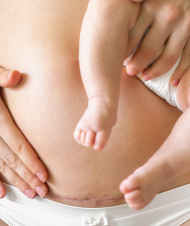 Caesarian scar support Brookvale Northern Beaches Caesarian scar support Brookvale Northern Beaches